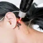 How Much Does Tattoo Removal Hurt?