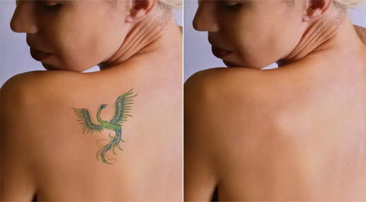 Tattoo Removal Near Me