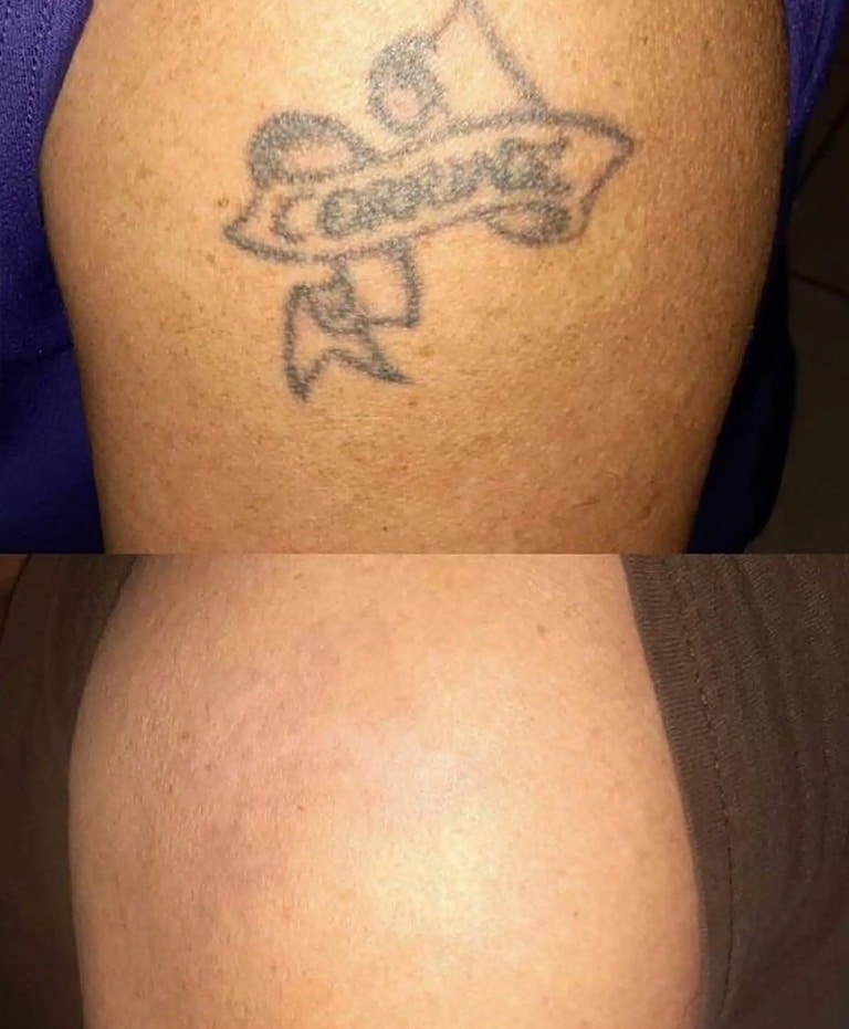 Tattoo Removal in Almonte Springs
