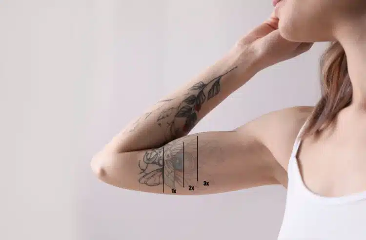 Best Tattoo Removal in Winter Park for 7 Years