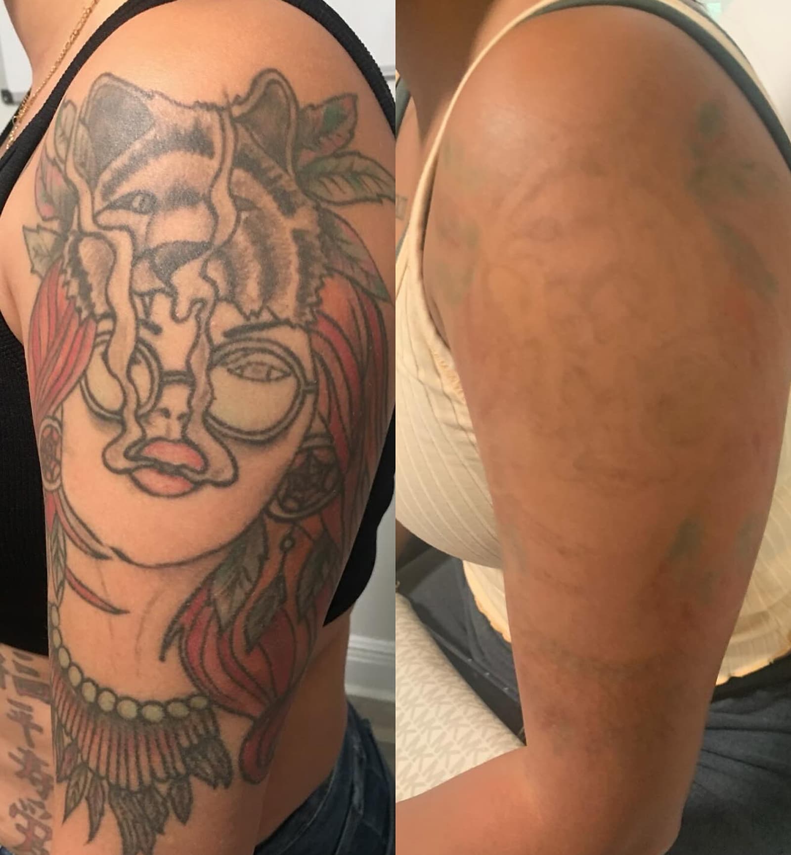 Tattoo Removal in Oviedo