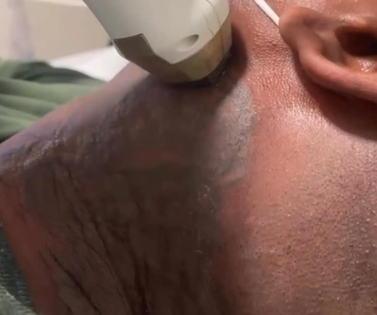 benefit from Scars Removal 