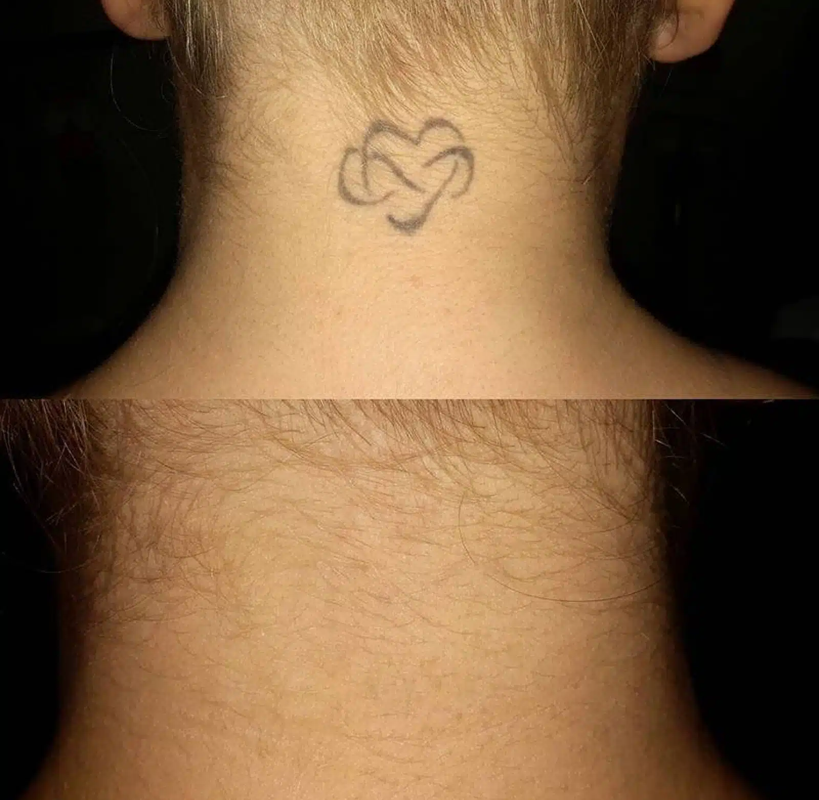 Laser Treatment Laser Treatment