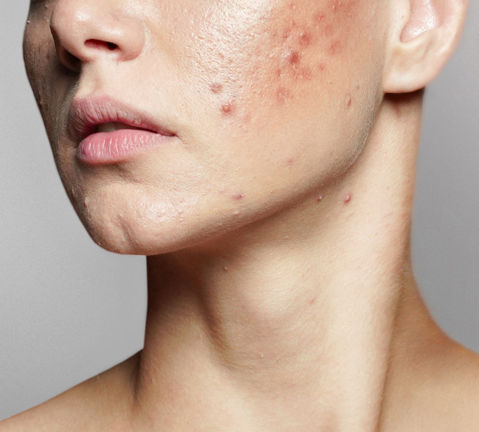 Acne Scars