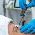Effective Tattoo Removal with PFD Patch