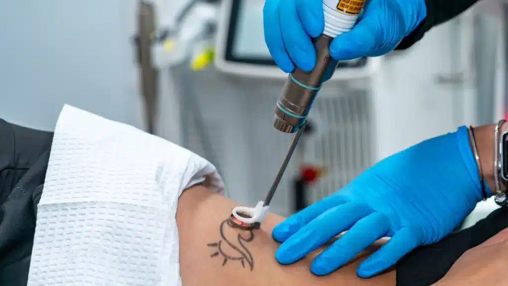 Effective Tattoo Removal with PFD Patch