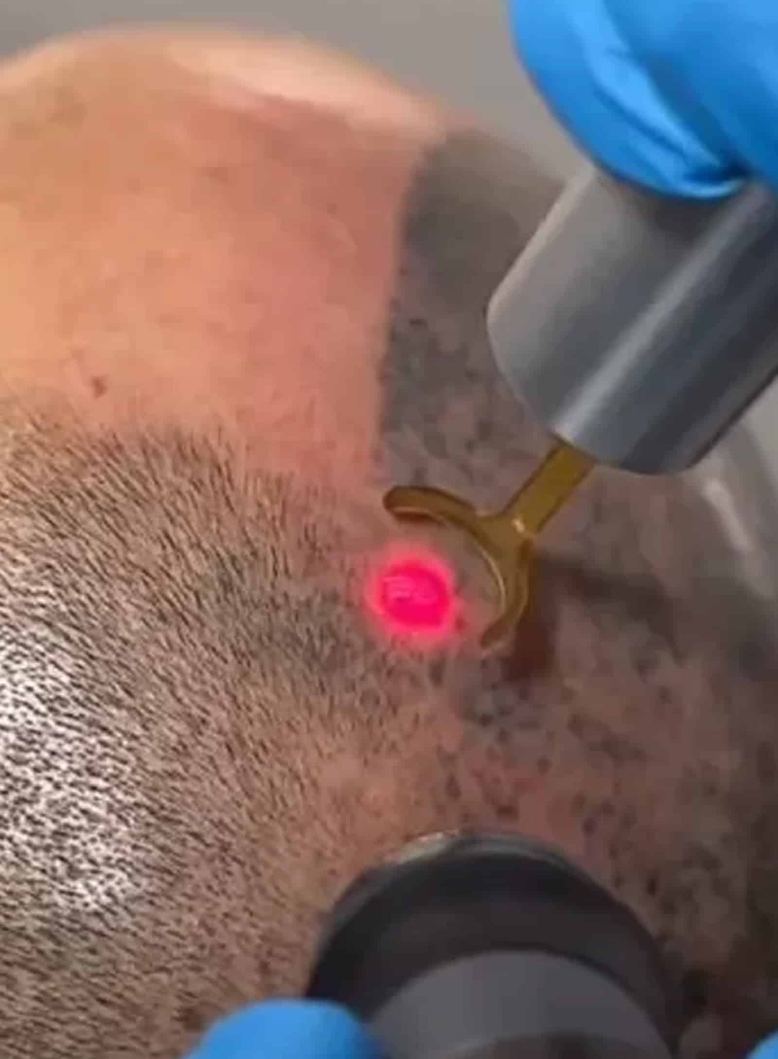 Laser SMP Removal Process