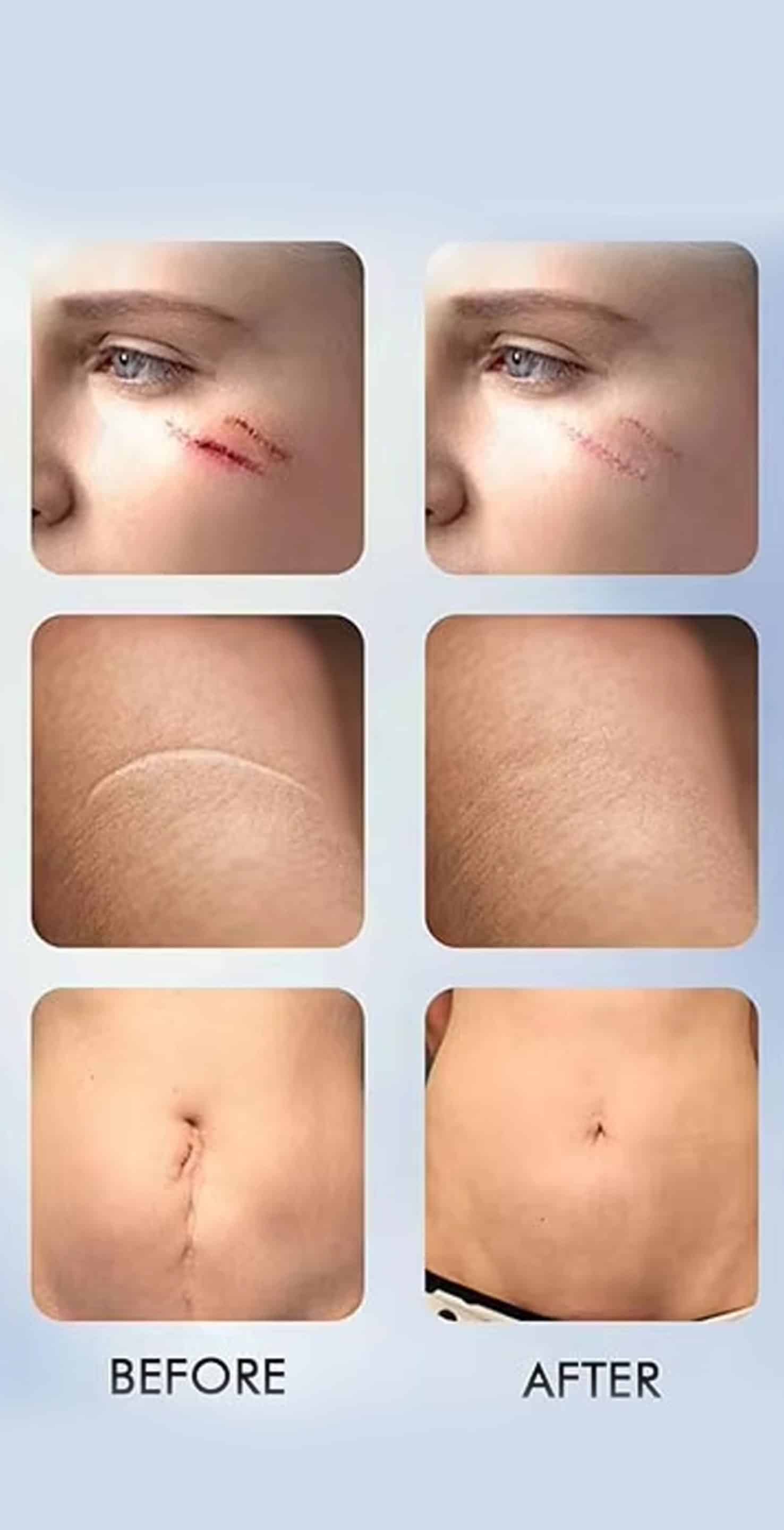 Laser Scar Treatment Process