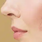 Laser Treatment For Pimple Scars