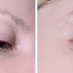 Laser Treatment for Keloid Scars