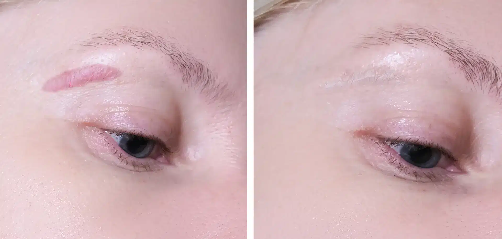 Laser Treatment for Keloid Scars