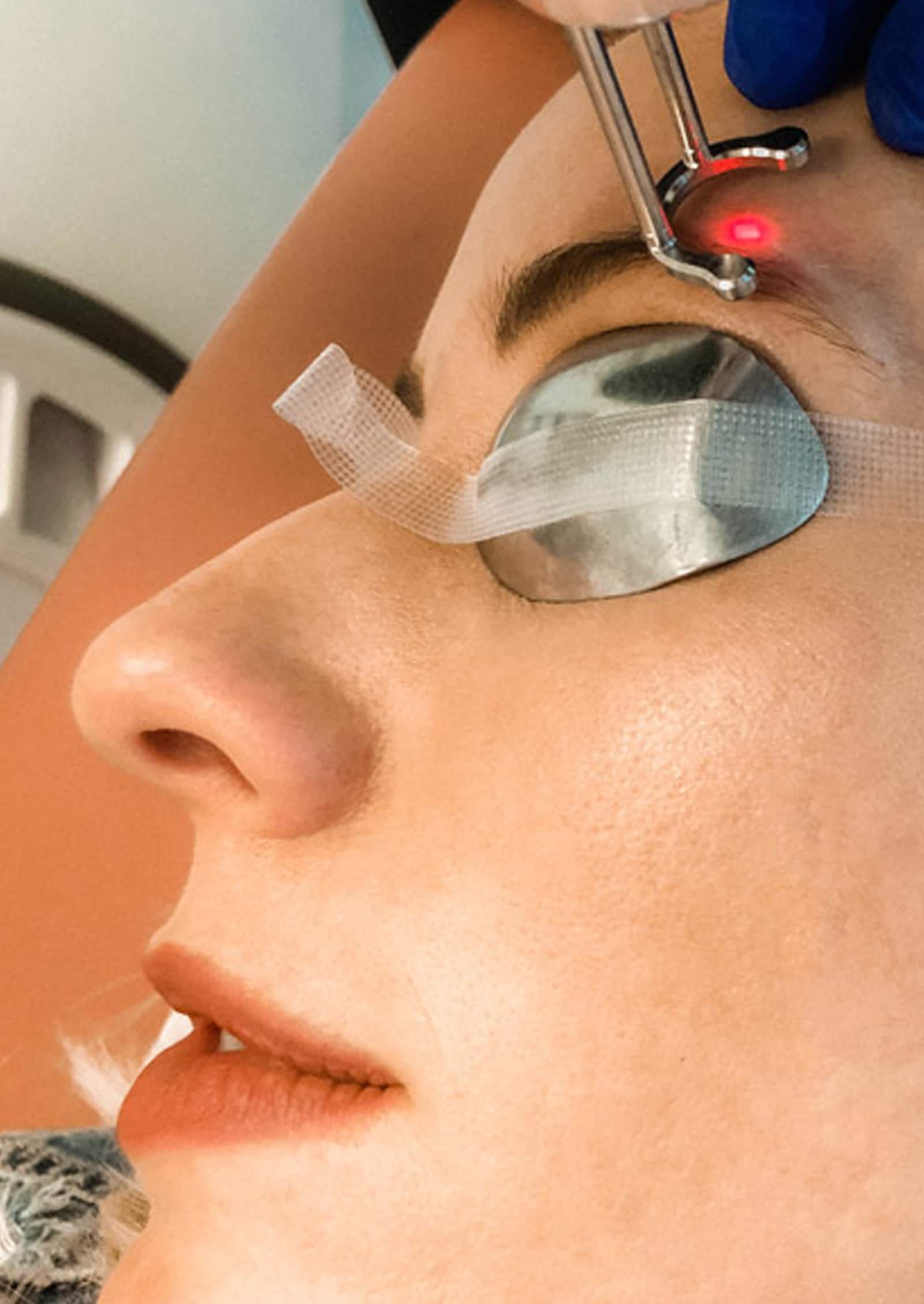 Laser Works for Microblading Removal