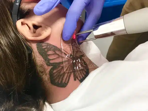 PFD Patch Tattoo Removal in Winter Park