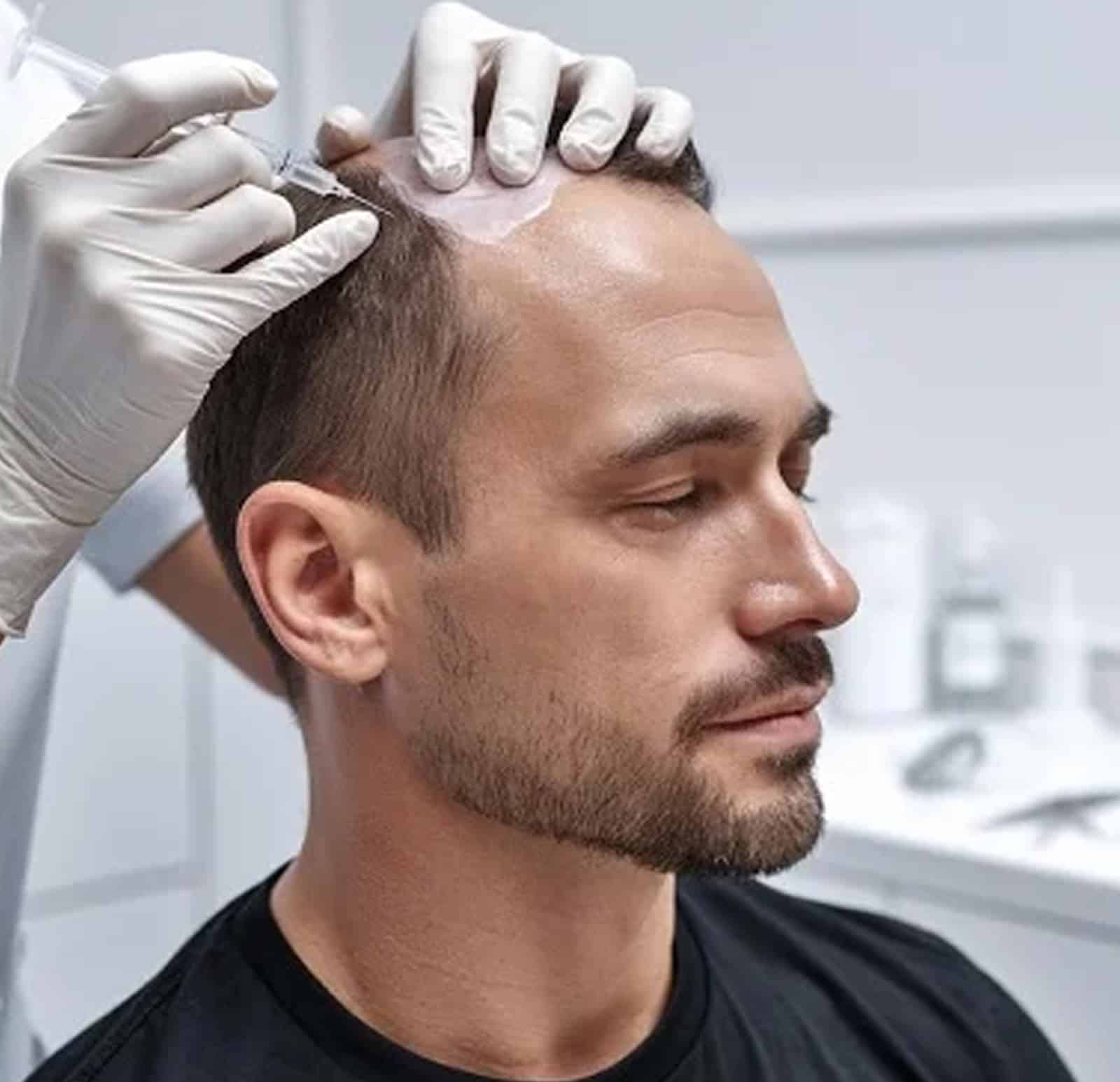Remove or Correct Scalp Micropigmentation