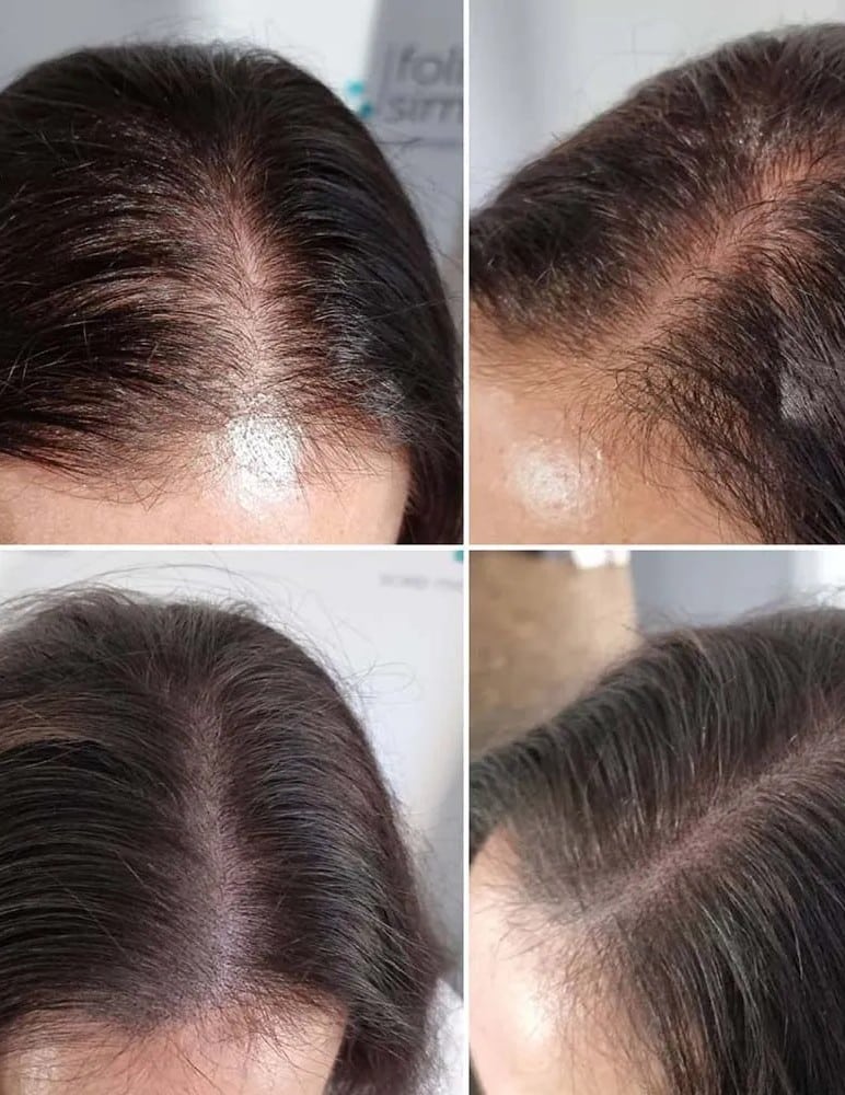Scalp Micropigmentation
