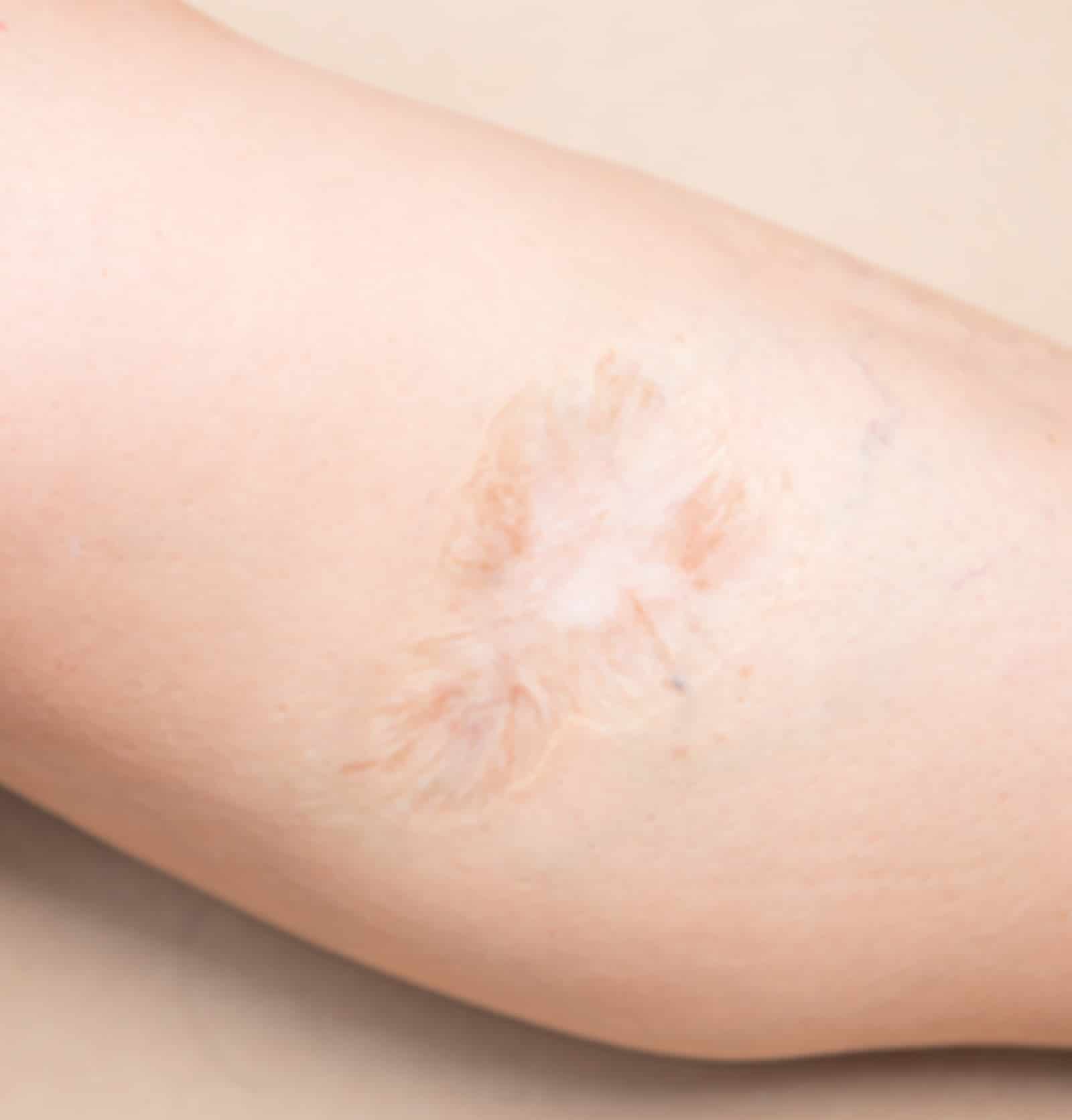 Surgical Scars