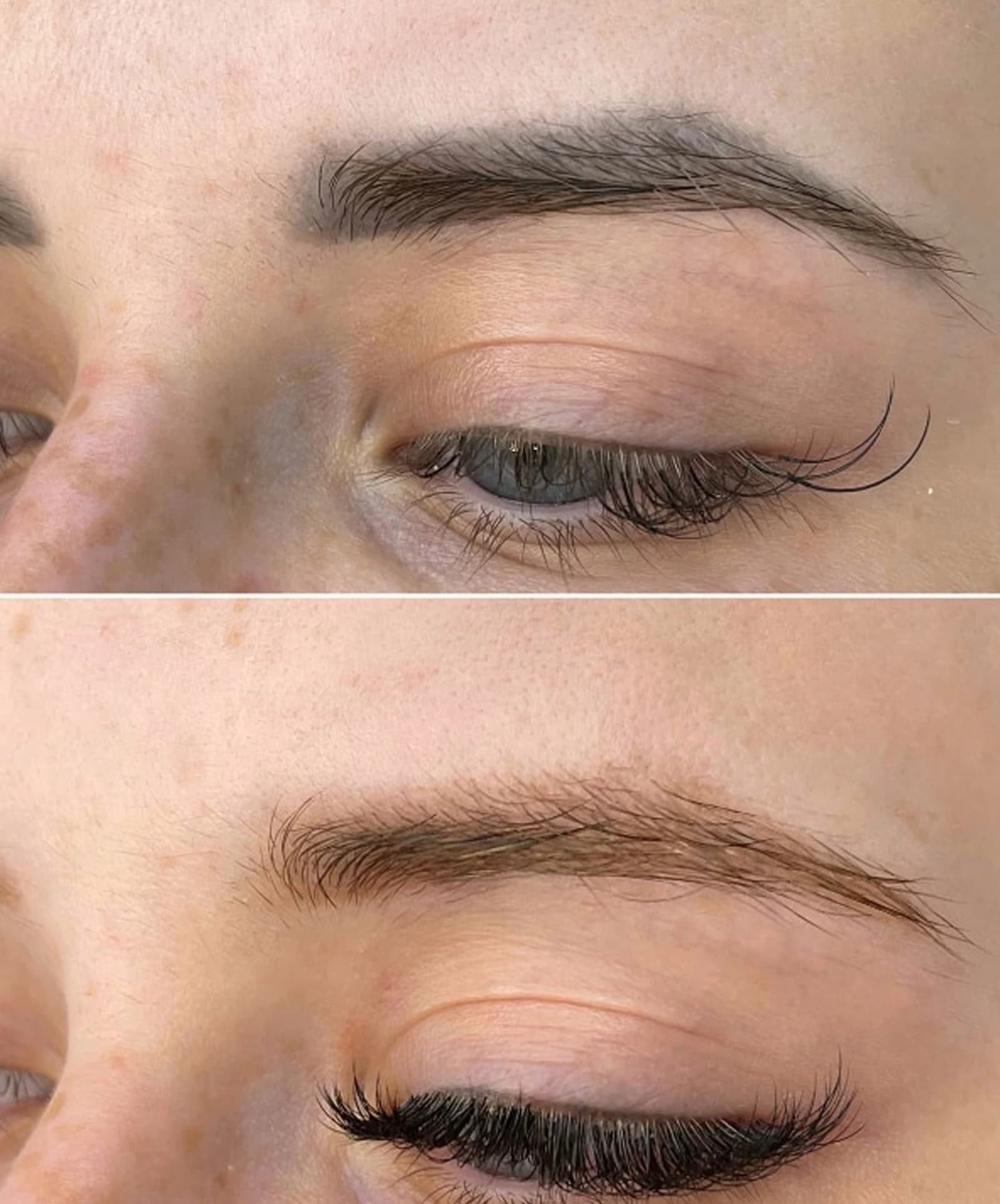 Winter Park Tattoo Removal