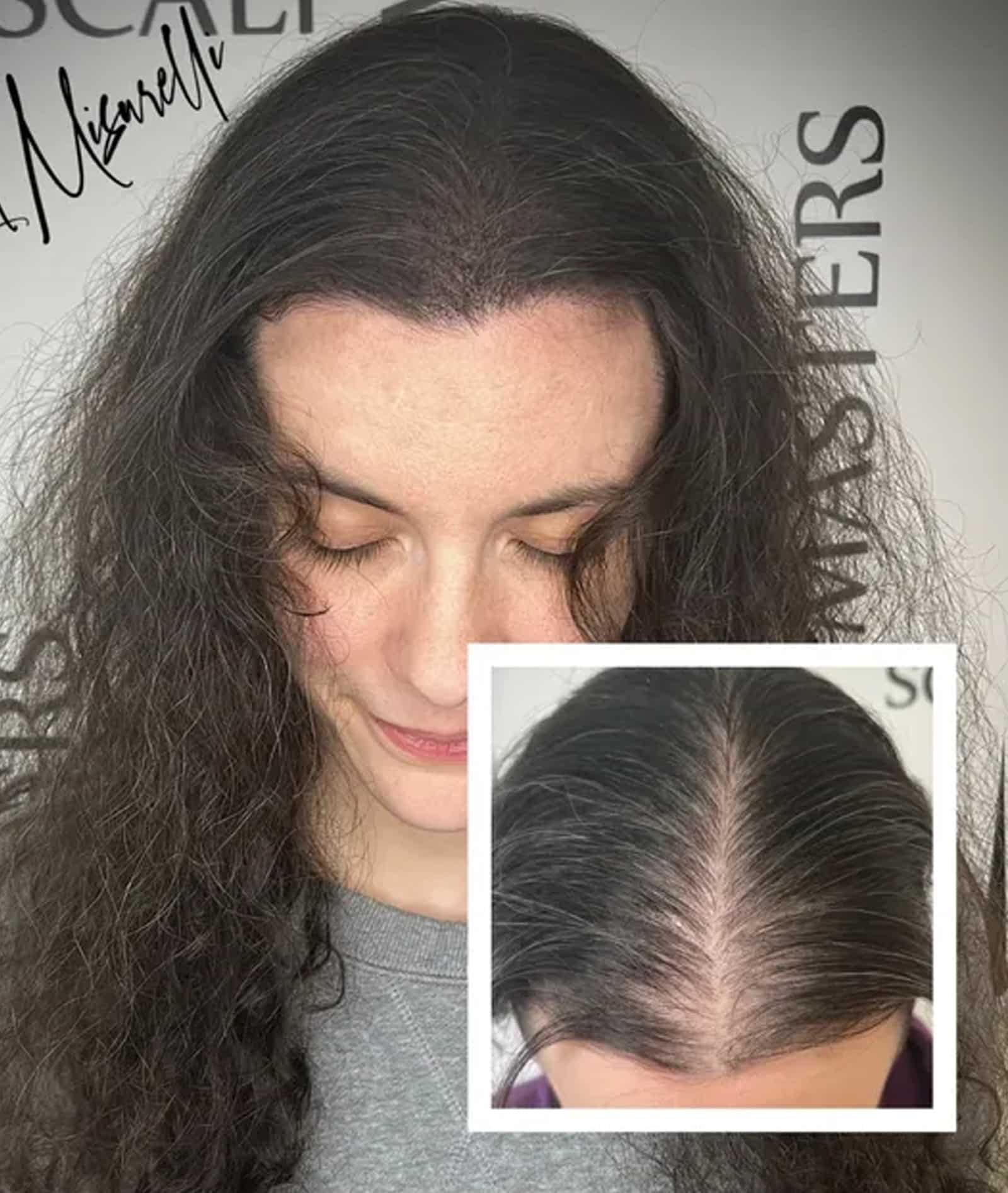 asics of Scalp Micropigmentation Explained