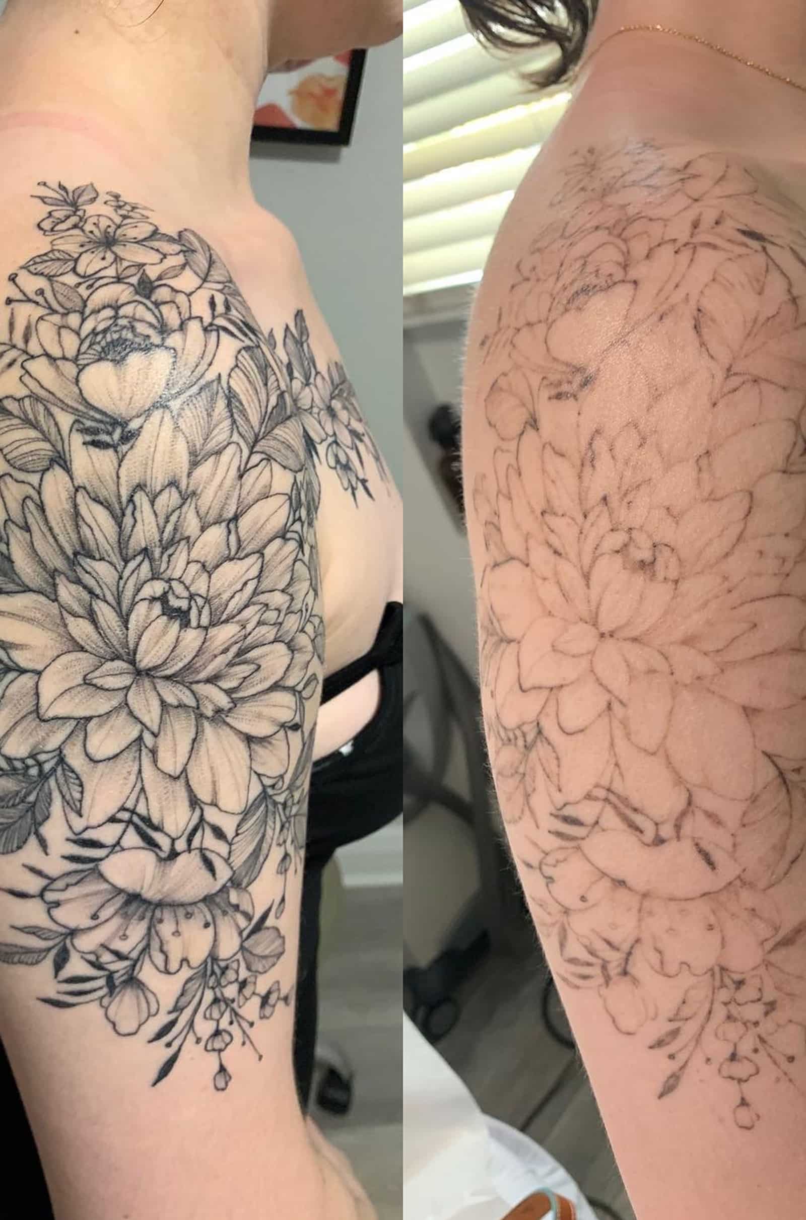 During Tattoo Removal