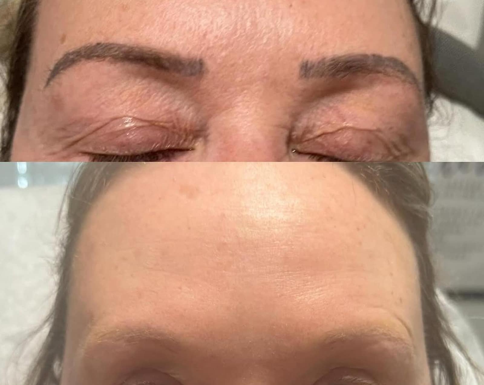 Microblading Removal