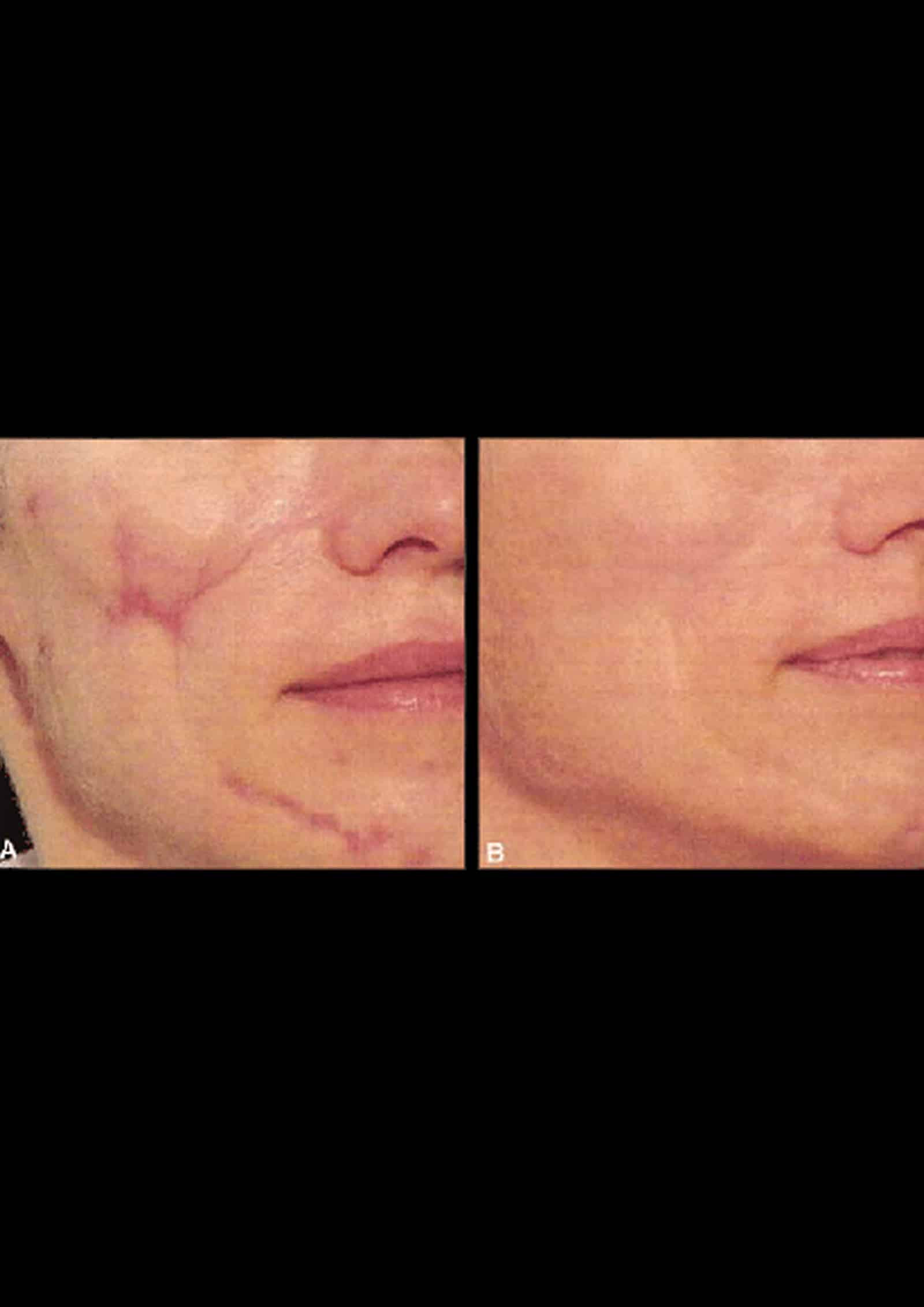 Non-Ablative (Fractional) Lasers