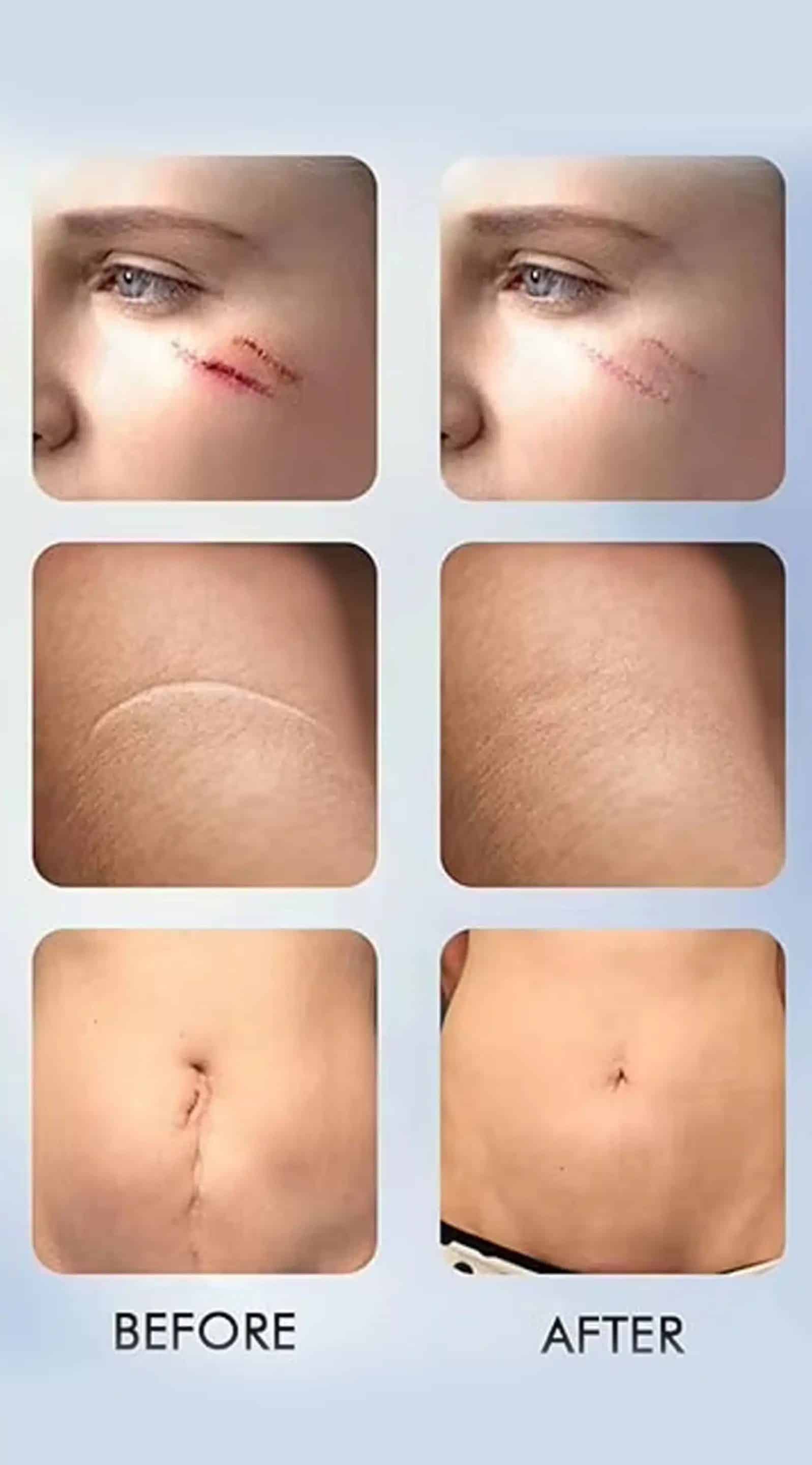 Types of Scars Treated with Laser Therapy