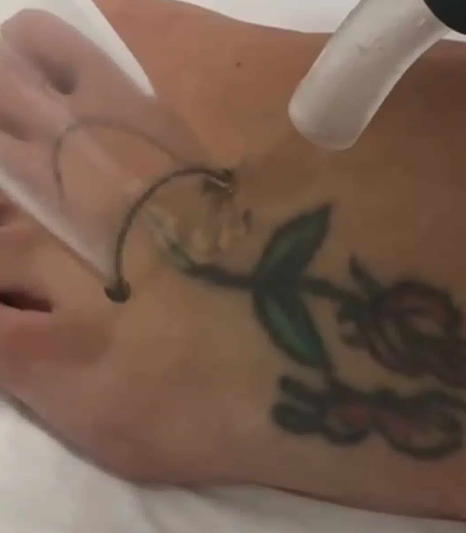 Winter Park Laser & Tattoo Removal