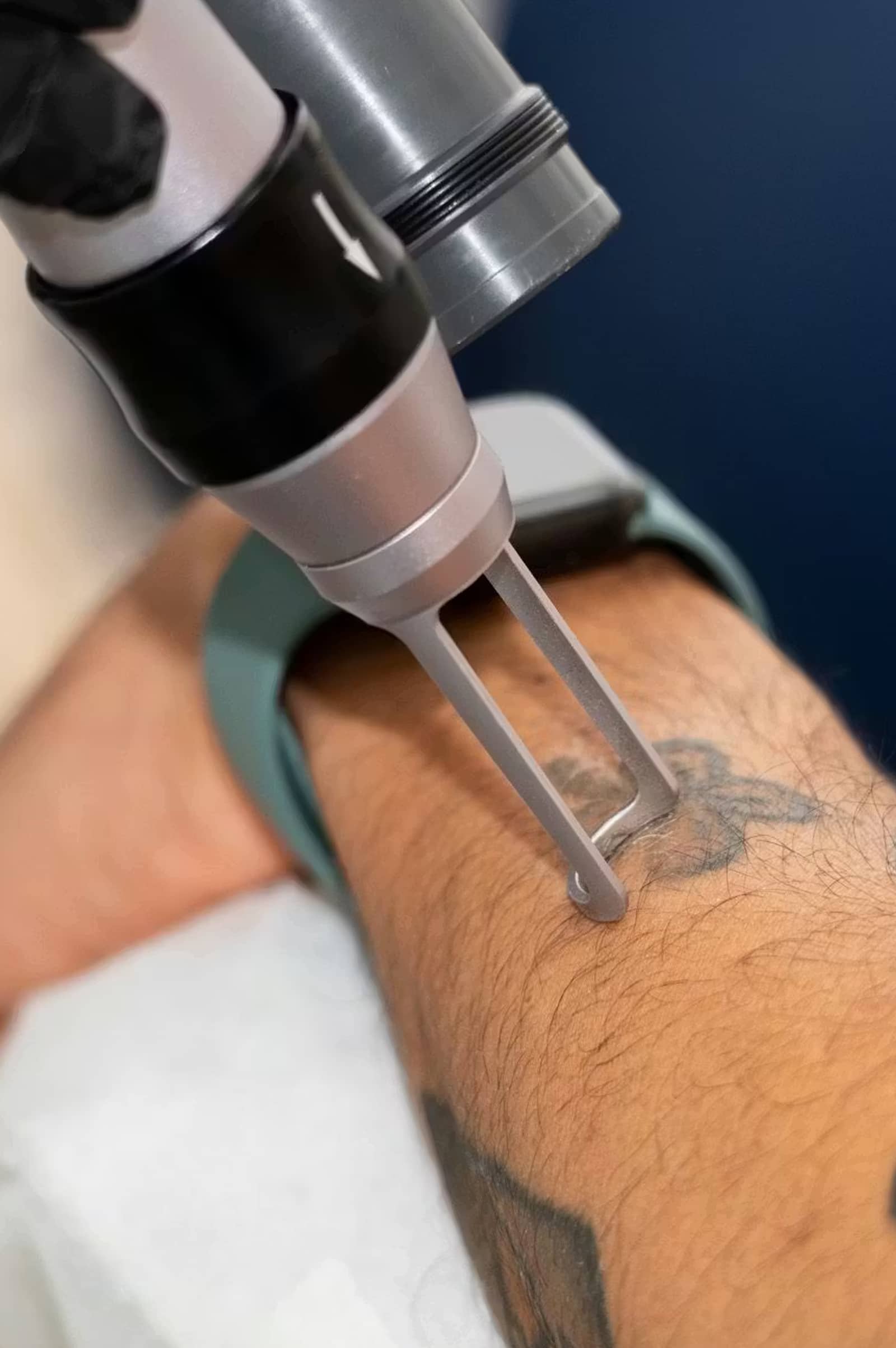 Winter Park Tattoo Removal is Your Trusted Choice