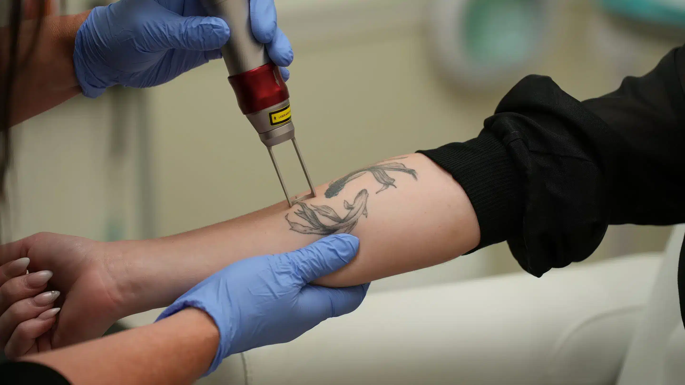 Does Lidocaine Help With Tattoo Removal Pain Does Lidocaine Help With Tattoo Removal Pain
