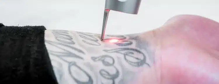 Does Pico Laser Work for Cover-Up Tattoos Does Pico Laser Work for Cover-Up Tattoos