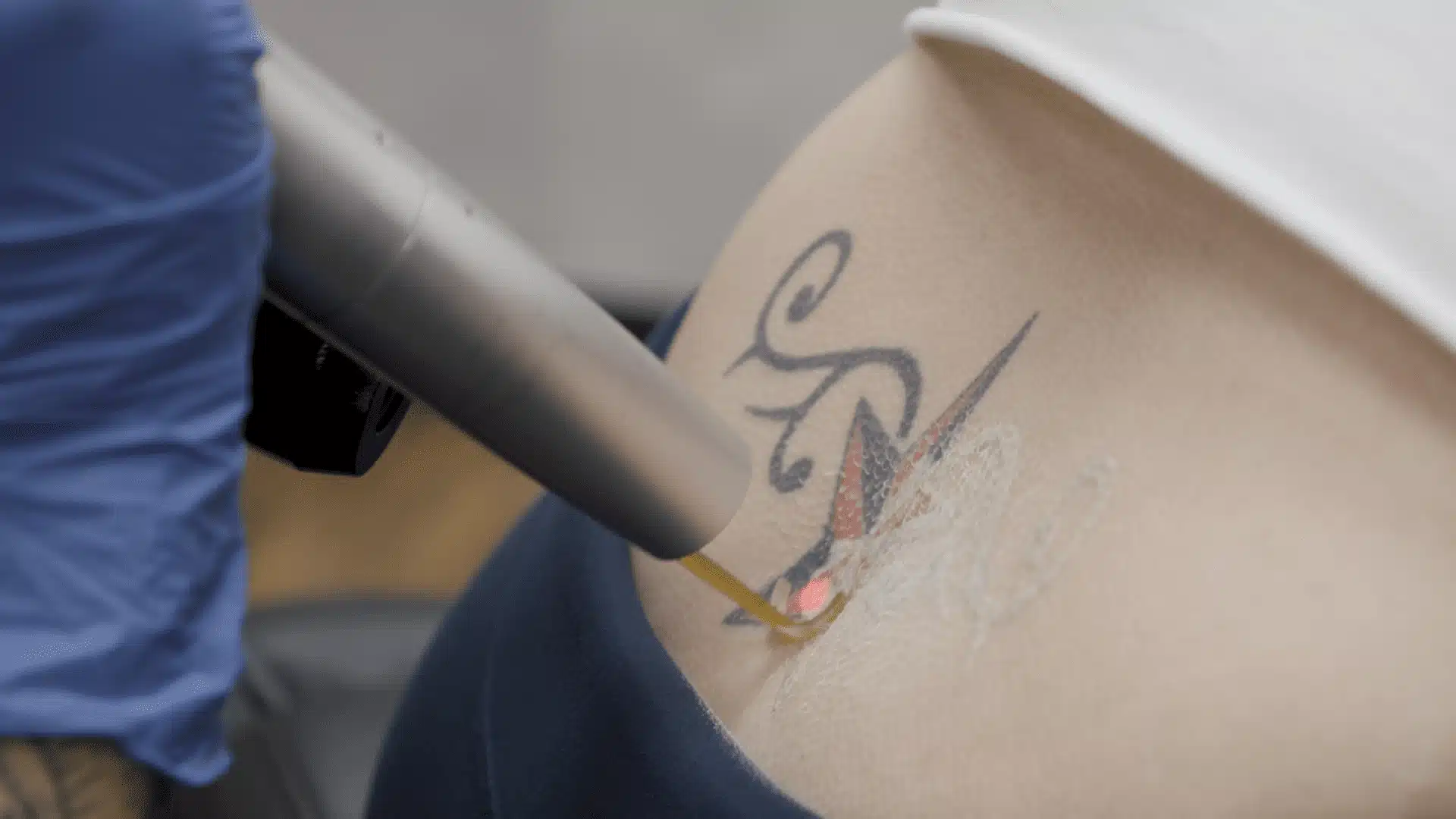 Does Pico Laser Work for Cover-Up Tattoos