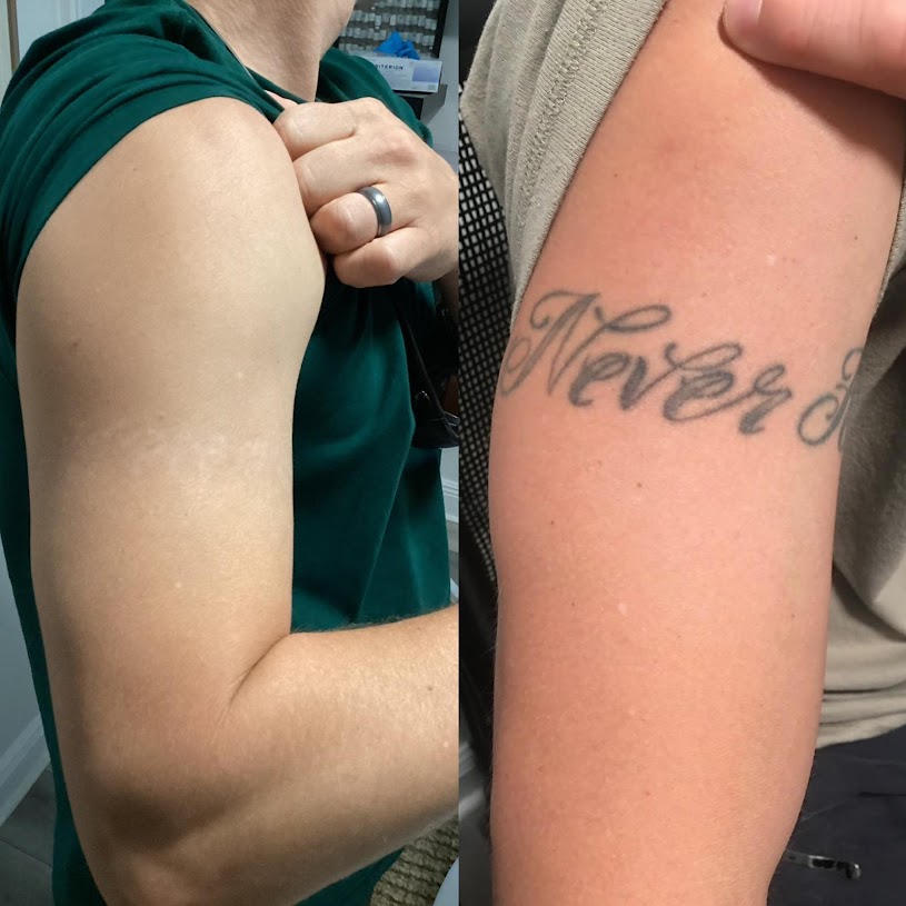 How Lidocaine Injections Work For Tattoo Removal