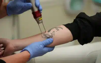 How Lidocaine Injections Work For Tattoo Removal