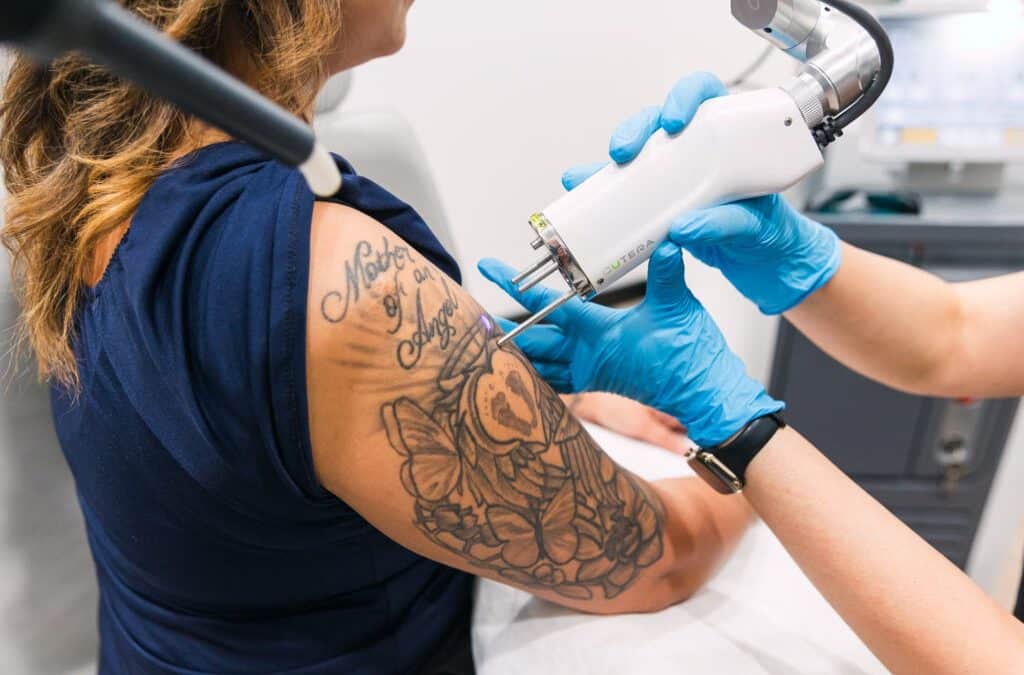 Pain-Free Tattoo Removal in Orlando: Numbing Solutions for Maximum Comfort